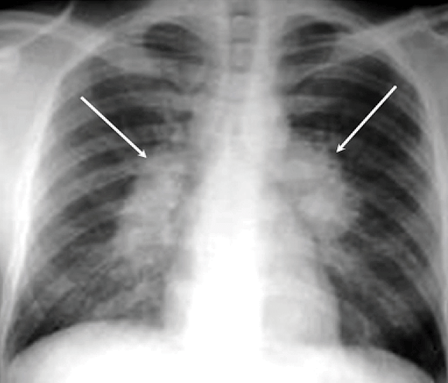 Туберкулез на рентгеновском снимке легких