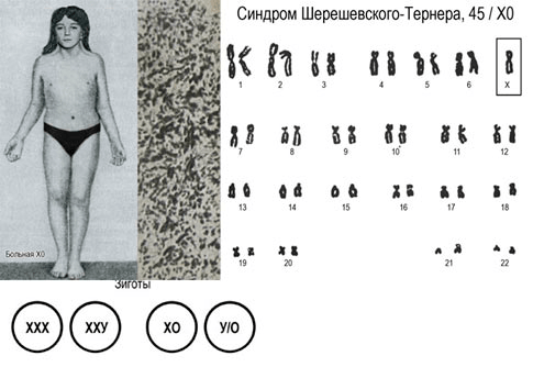 Фотография женщины с синдромом Шерешевского-Тернера и ее кариотип