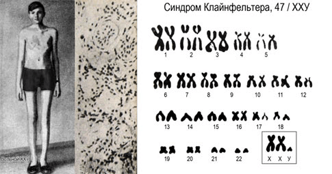 Фотография больного с синдромом Кляйнфельтера и его кариотип