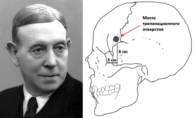 Эгаш Мониш и лоботомия