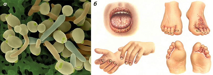 Candida albicans и кандидоз