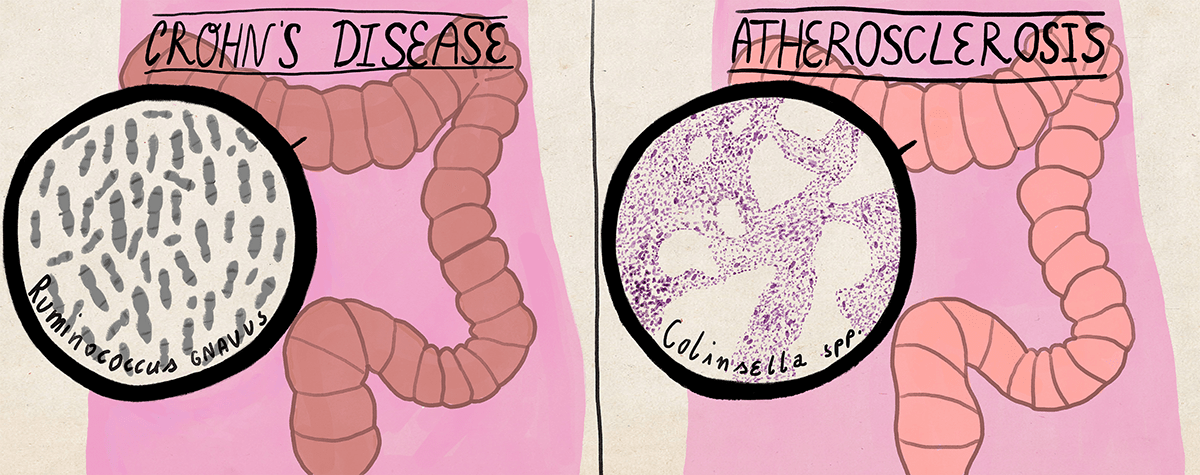 Болезнь Крона, атеросклероз и микробиом