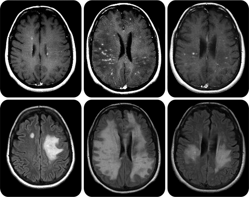 Очаги поражения центральной нервной системы при рассеянном склерозе
