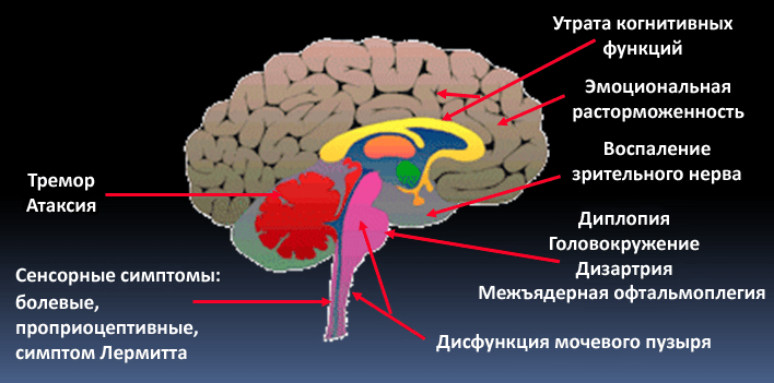 Симптоматика при рассеянном склерозе