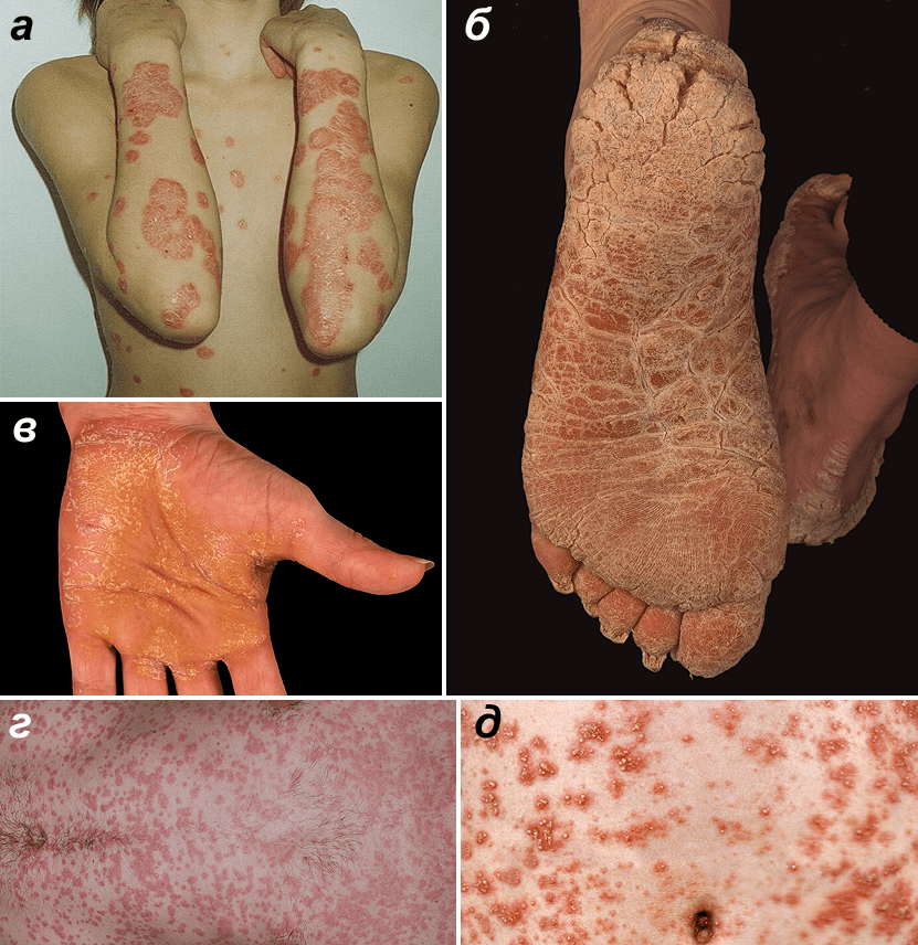 Формы псориаза