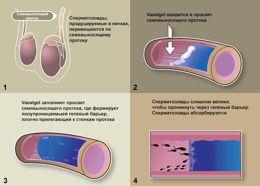 Как работает Vasalgel?