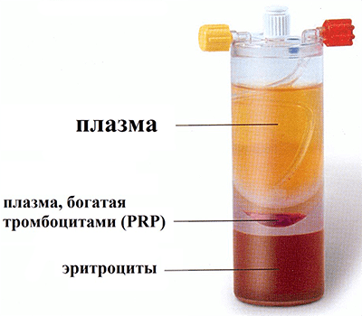 Плазма, обогащённая тромбоцитами