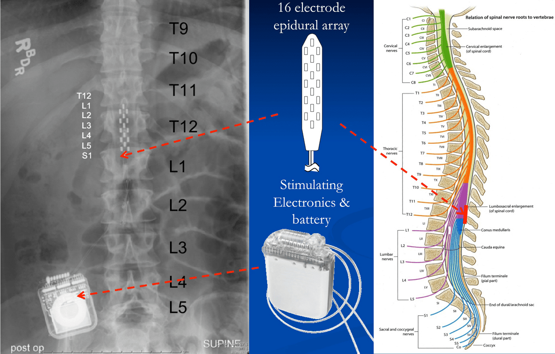 Эпидуральная стимуляция спинного мозга