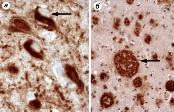 Гистологические признаки болезни Альцгеймера