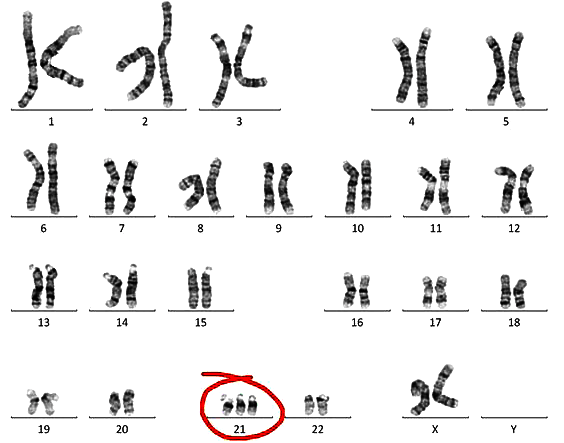 Кариотип пациента с синдромом Дауна