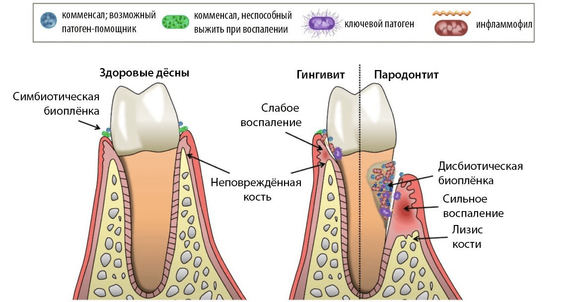 Норма, гингивит и пародонтит