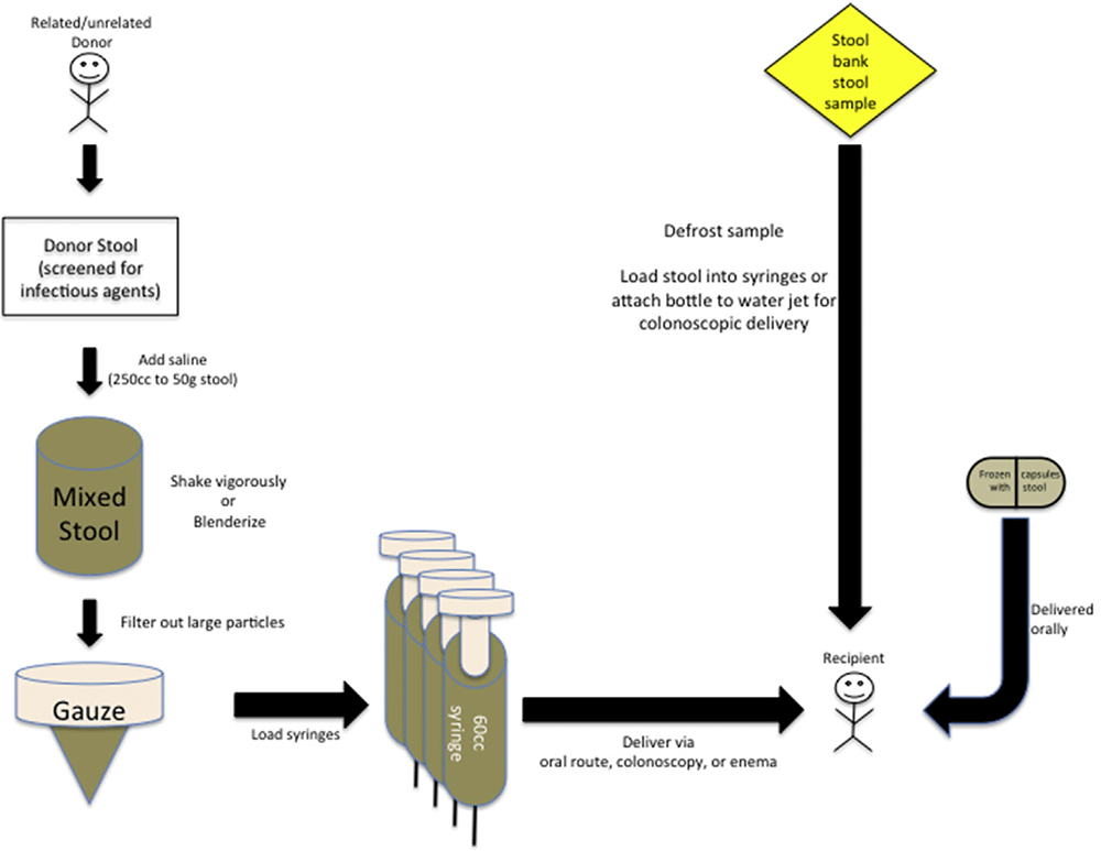 Этапы проведения фекотрансплантации