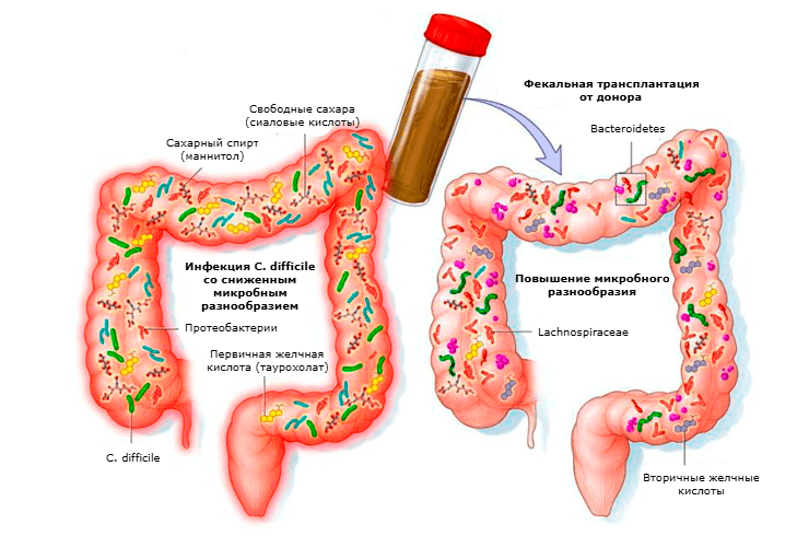 Схема FMT-терапии при рецидивирующей CDI