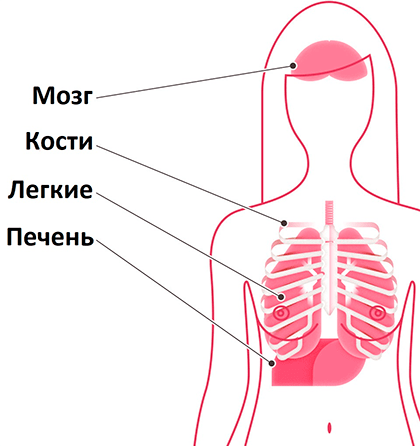 Очаги возникновения вторичной опухоли при РМЖ