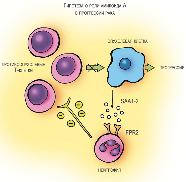 Амилоид A и рак
