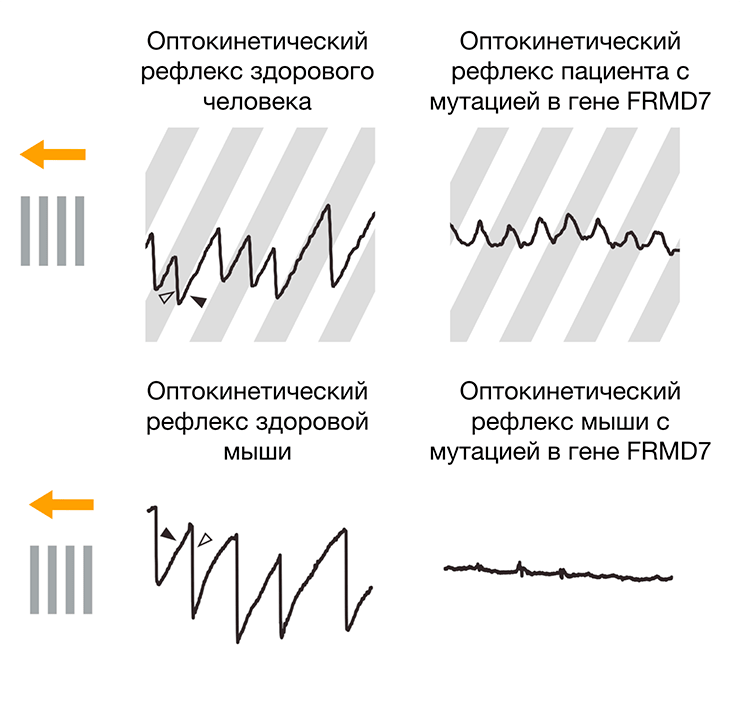 Фенотип при наличии мутации в гене FRMD7