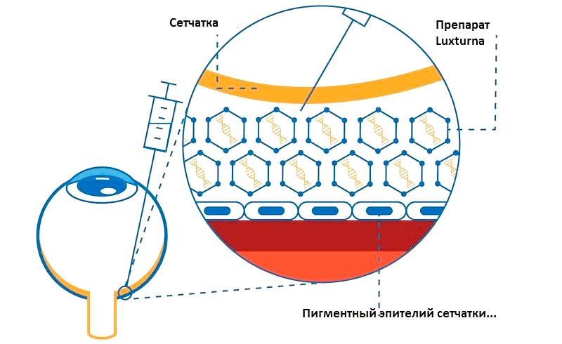 Схема работы генетической терапии Luxturna