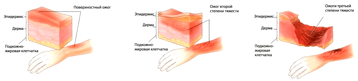 Стадии ожога