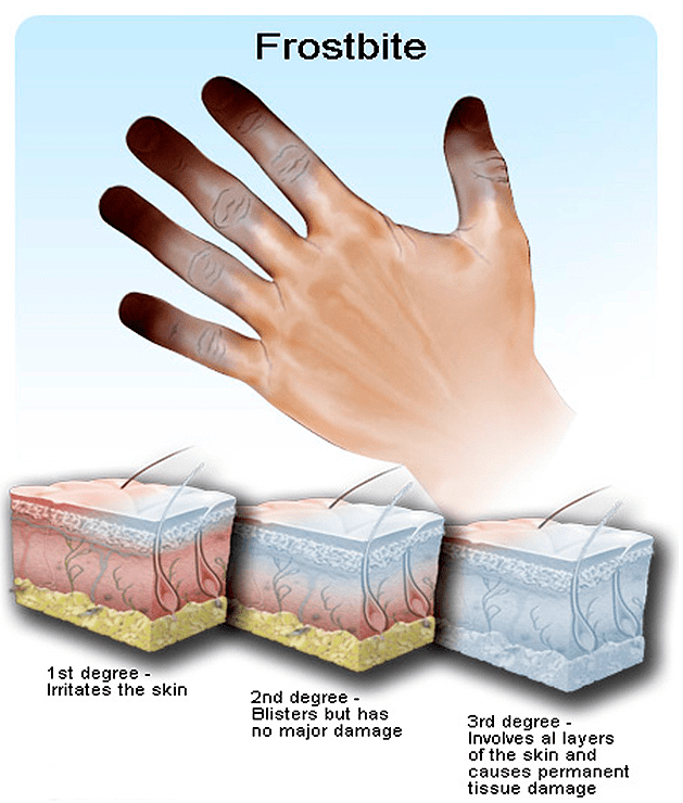 Стадии обморожения