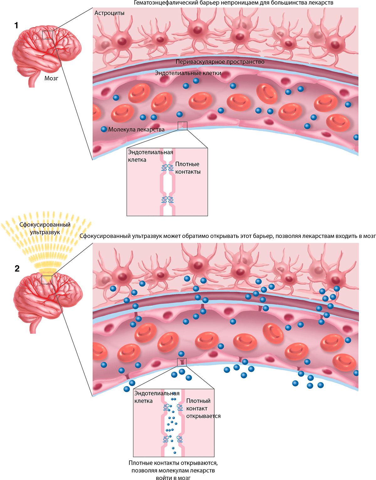 Открытие гематоэнцефалического барьера для доставки лекарств