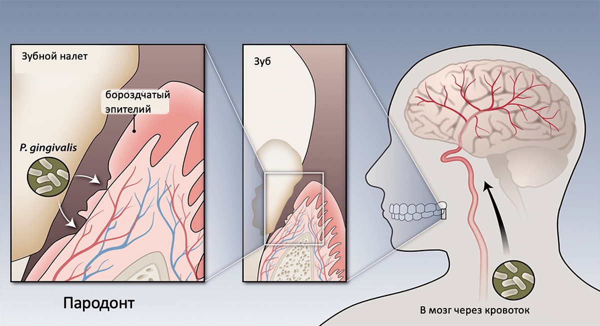 P. gingivalis проникает в мозг