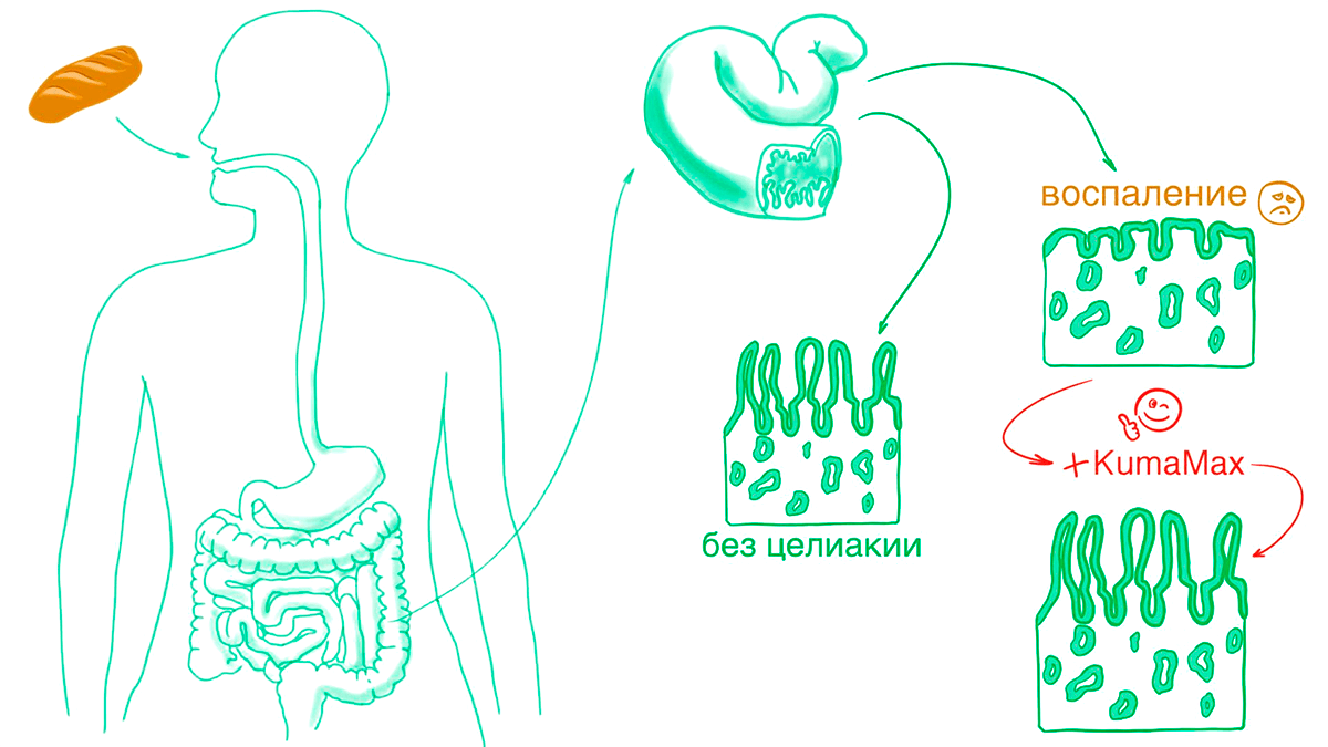 Целиакия и ее лечение