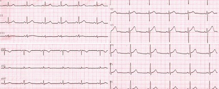 ЭКГ здорового человека