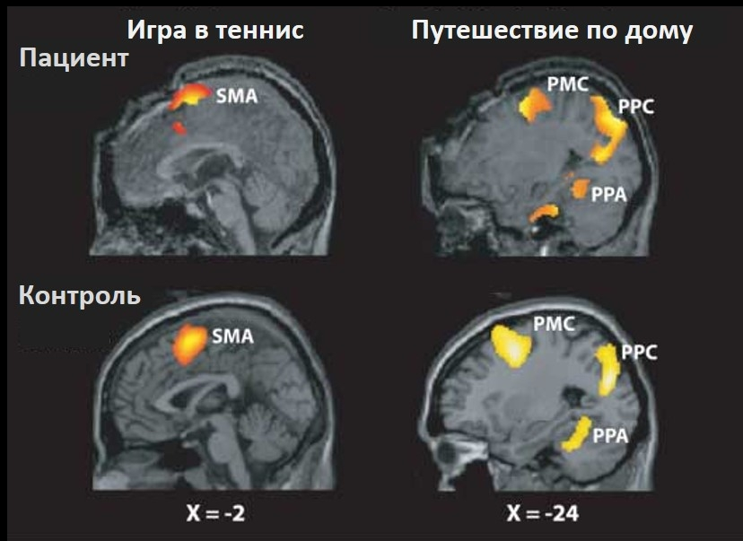 Cправа: активация дополнительной моторной области