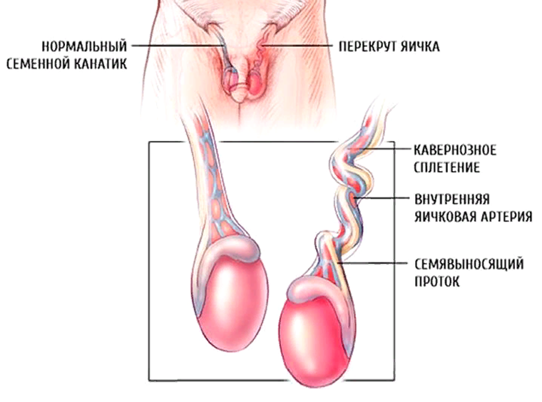 Перекрут семенного канатика