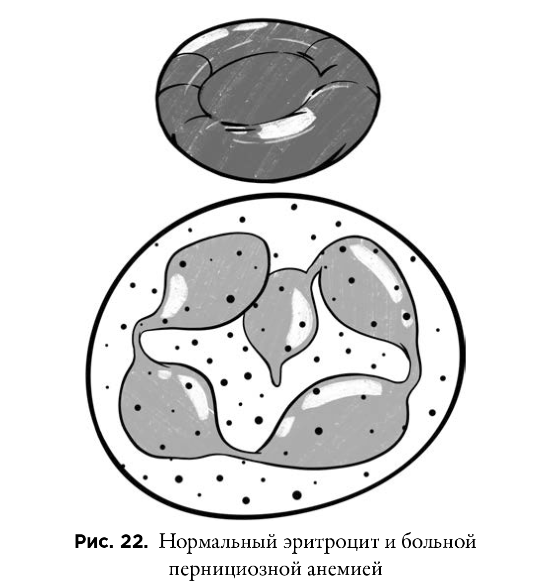 Схематические изображение патологии эритроцитов