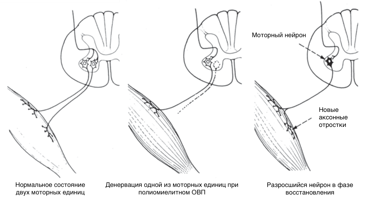 Денервация и повторная иннервация мышц при полиомиелите