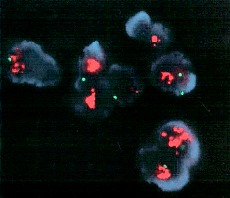 Методами молекулярной цитогенетики можно выявить изменения, связанные с раком