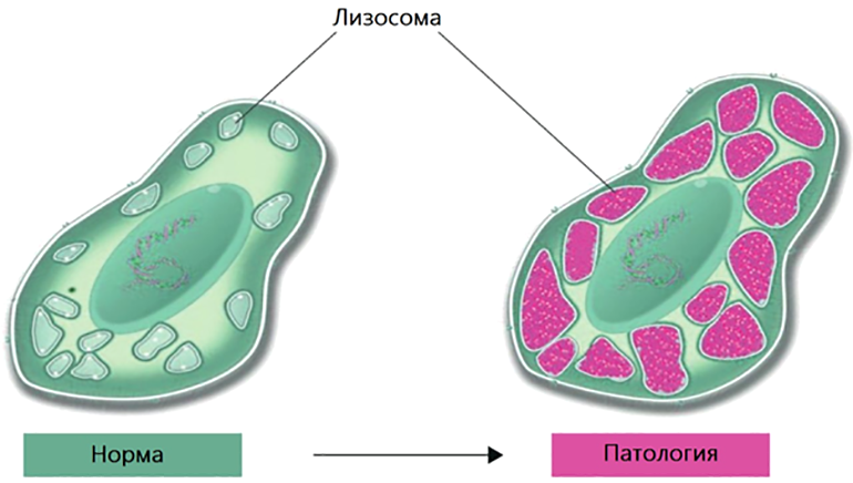 Лизосомальные нарушения накопления сфинголипидов вызывают патологическое разрастание органелл при болезни Фабри