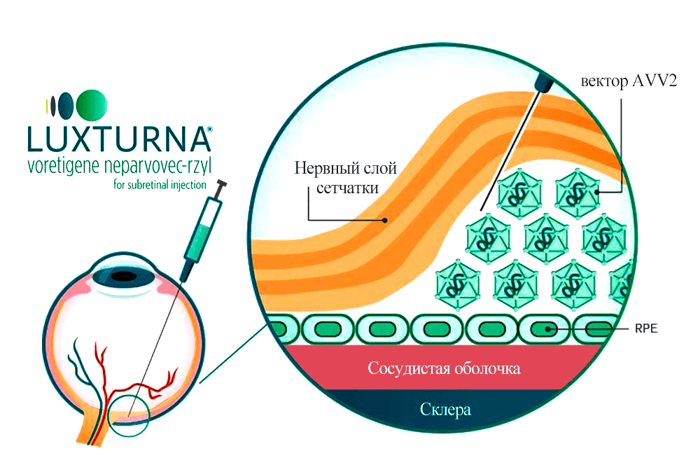 Субретинальное введение препарата