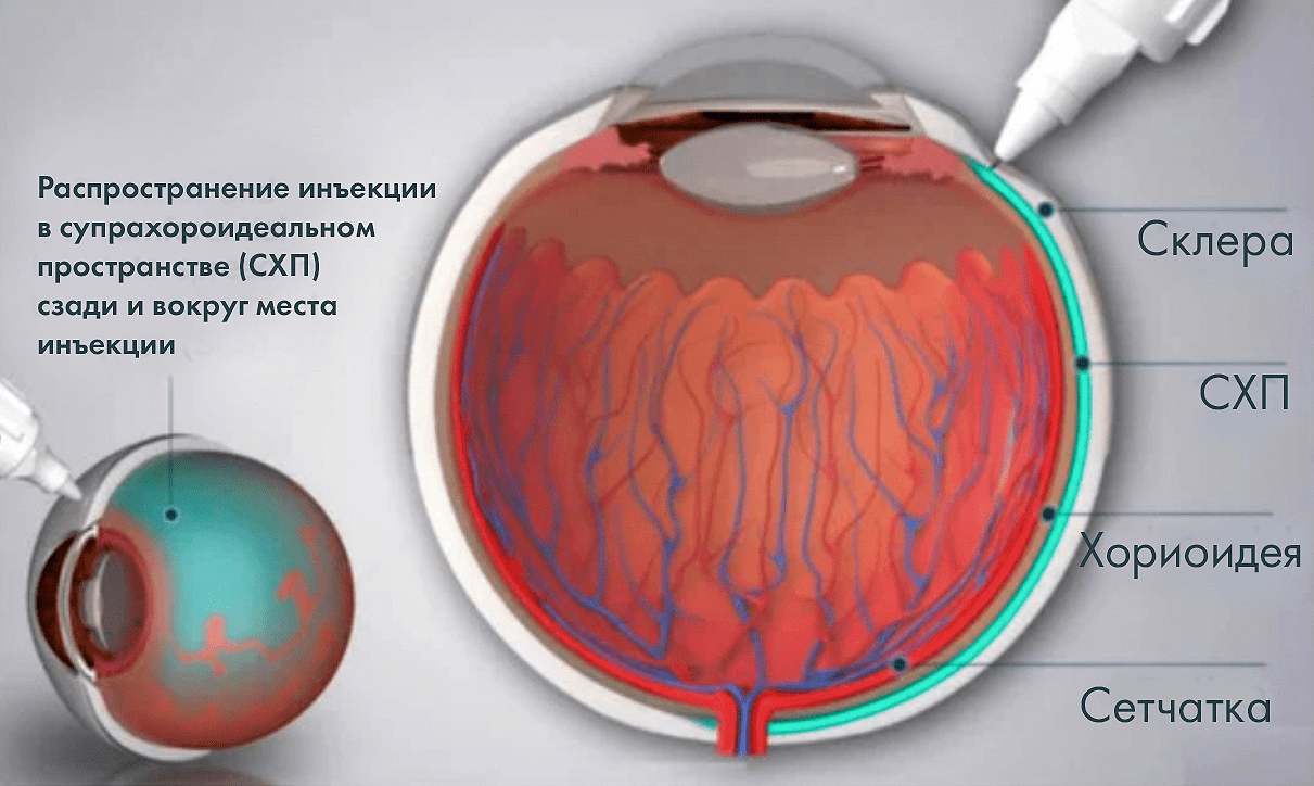 Распределение введенного препарата после супрахориоидальной инъекции