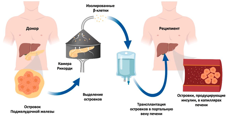 Выделение островков поджелудочной железы с их последующей трансплантацией в портальную вену печени пациента