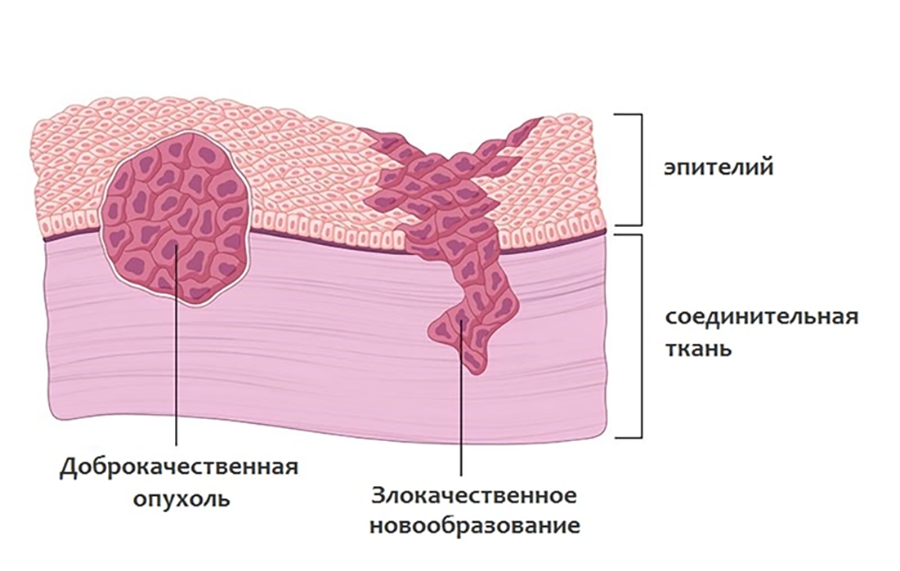 Различия между доброкачественными и злокачественными опухолями.