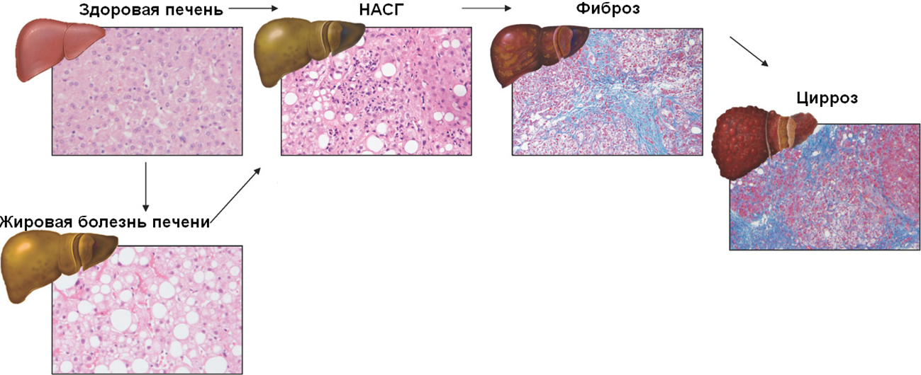 Прогрессия метаболического поражения печени