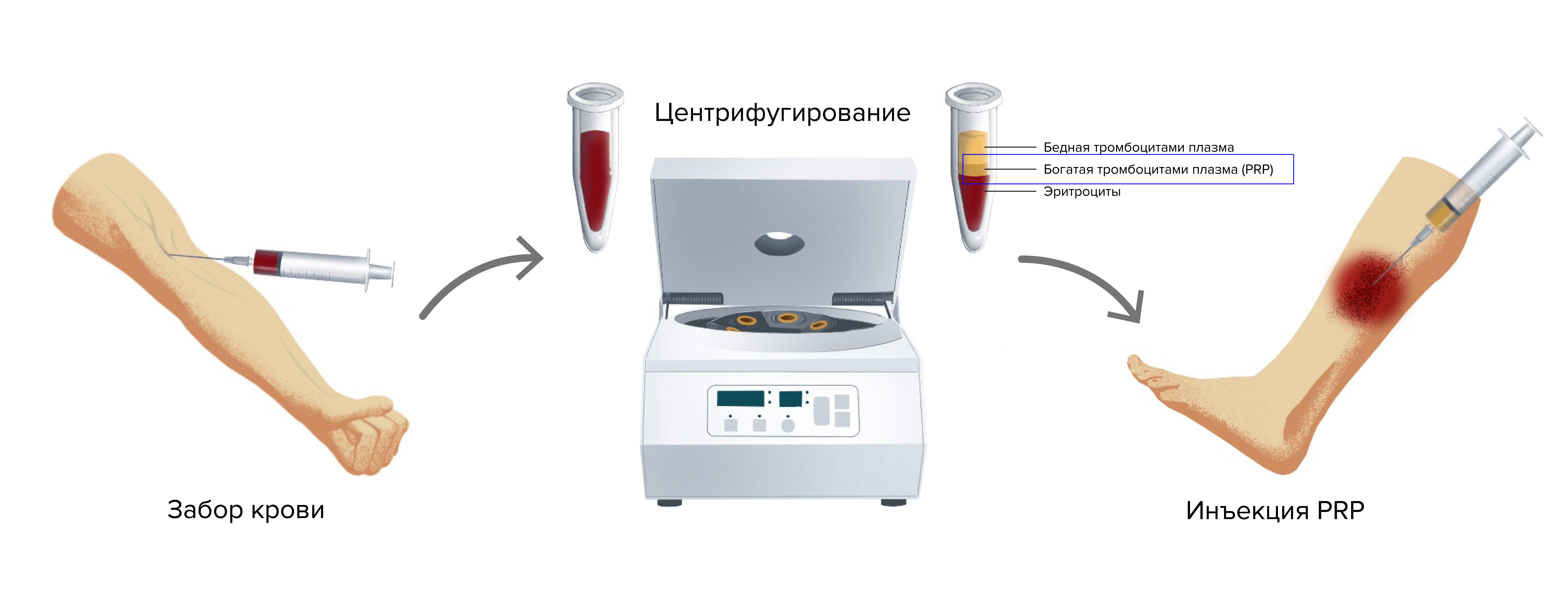 Рисунок 20. Так работает PRP-терапия