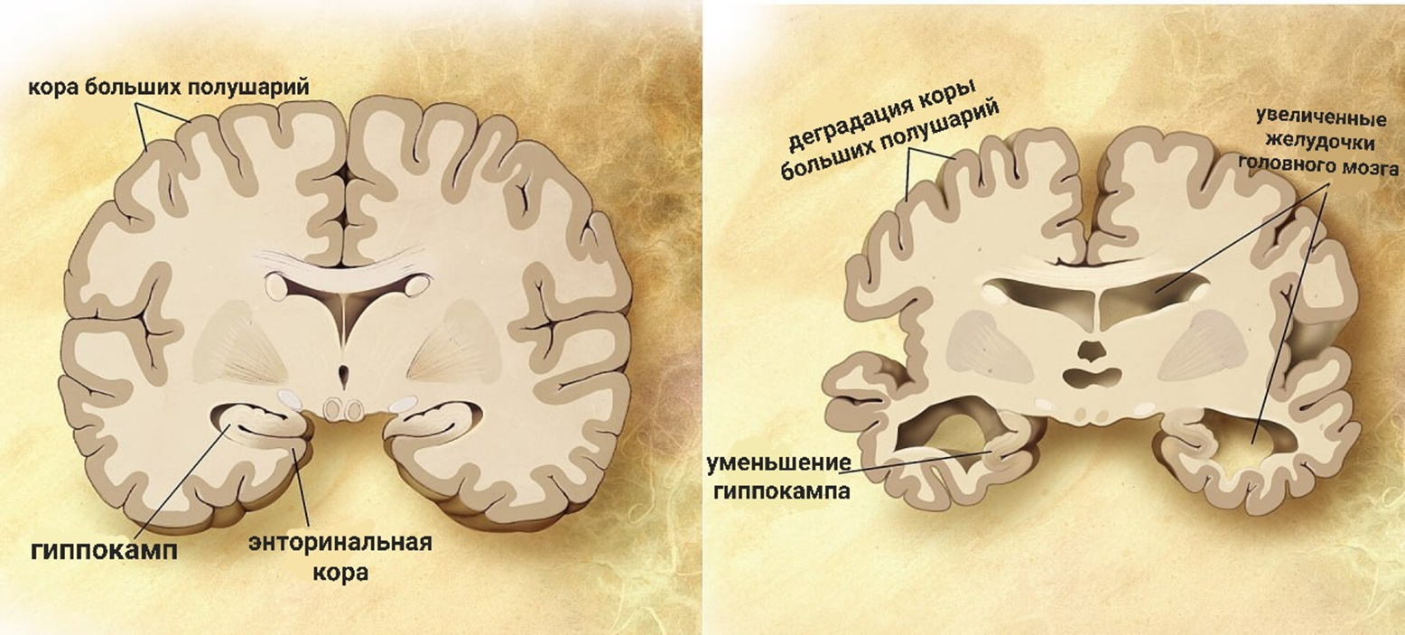 Мозг пожилого человека в норме (слева) и при болезни Альцгеймера (справа)