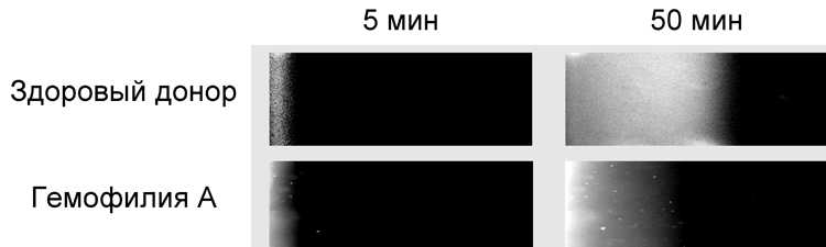 Пространственный рост фибринового сгустка в норме и патологии