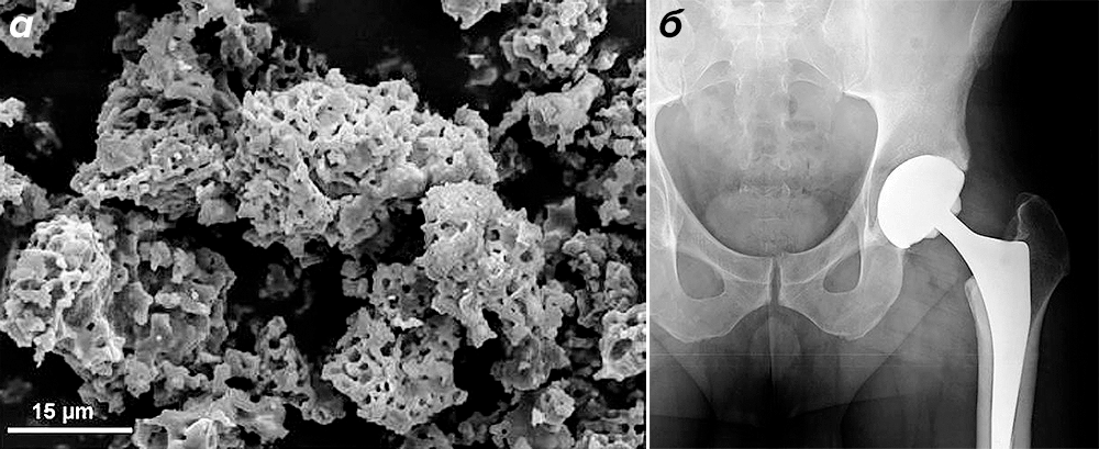 Покрытие из биоактивной керамики на протезе тазобедренного сустава